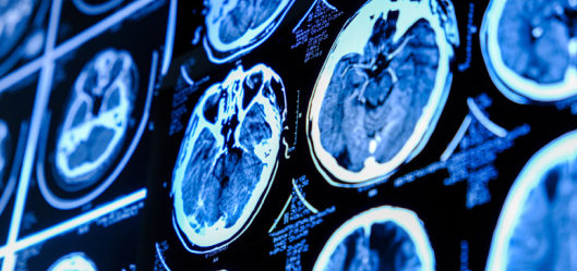 Low Volume High Complexity National Chordoma and Chondrosarcoma skull base National MDT